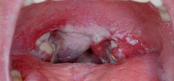 Strep throat rash adult